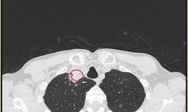 Case infected with killer plant fungus found in Kolkata: This is the first case in the world