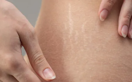 Adopt these remedies to get relief stretch marks